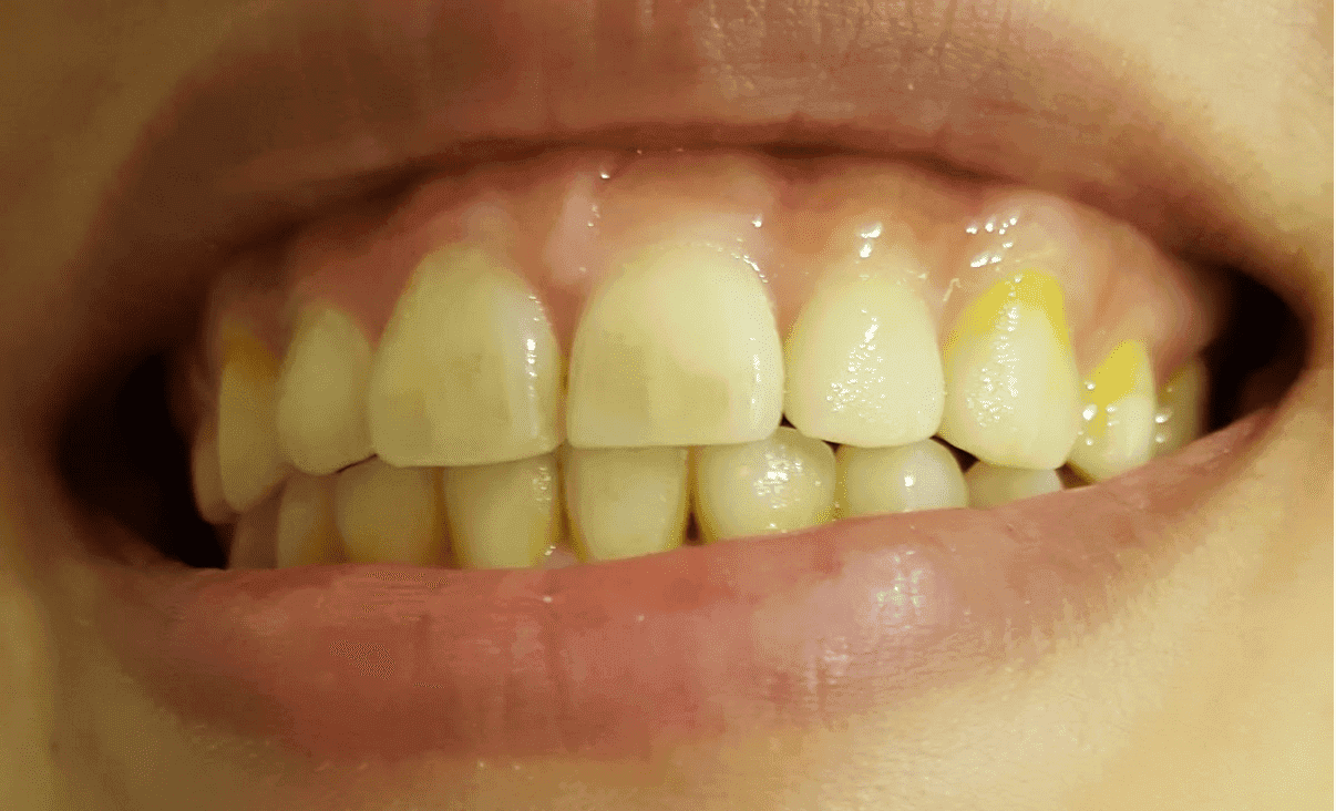 迪昇牙醫冷光美白心得（友情贊助文）